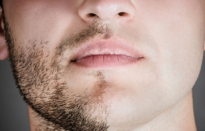 فرایند لیزر موهای زائد به بافت پوست آسیب میرساند؟