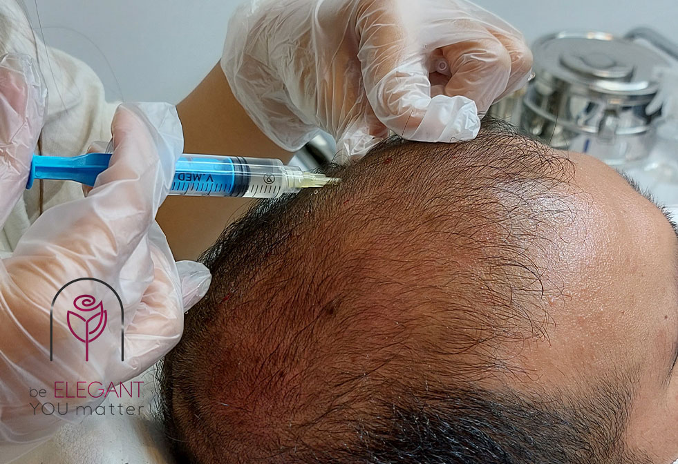 تزریق مزوتراپی چگونه می‌تواند باعث درمان ریزش مو شود؟