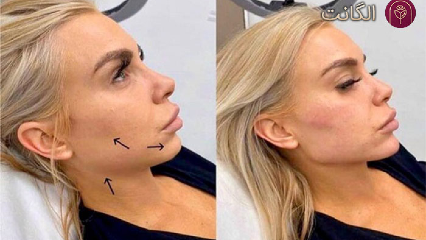 زاویه سازی فک