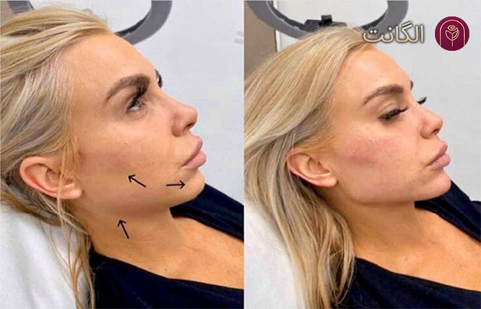 زاویه سازی فک  برای چه کسانی مناسب است؟