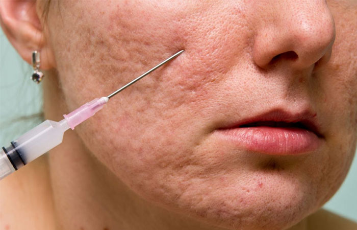 انواع جای جوش