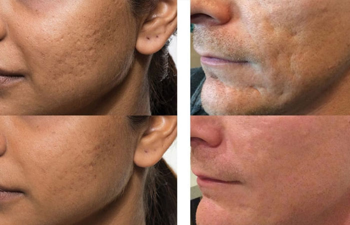 انواع مختلف تزریق ژل برای جای جوش