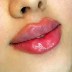 تزریق ژل در بهترین کلینیک زیبایی ساری