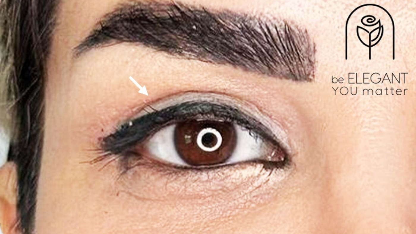 بلفاروپلاستی در ساری