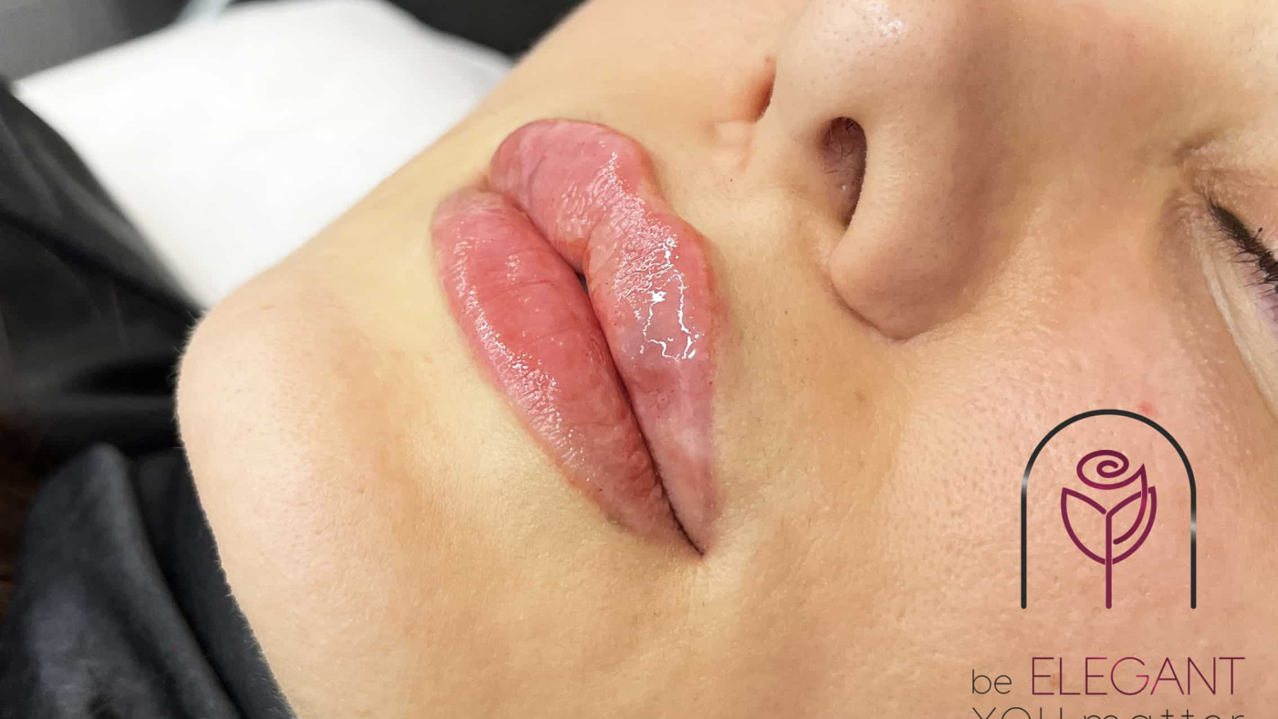 ،رم لب برای تزریق فیلر