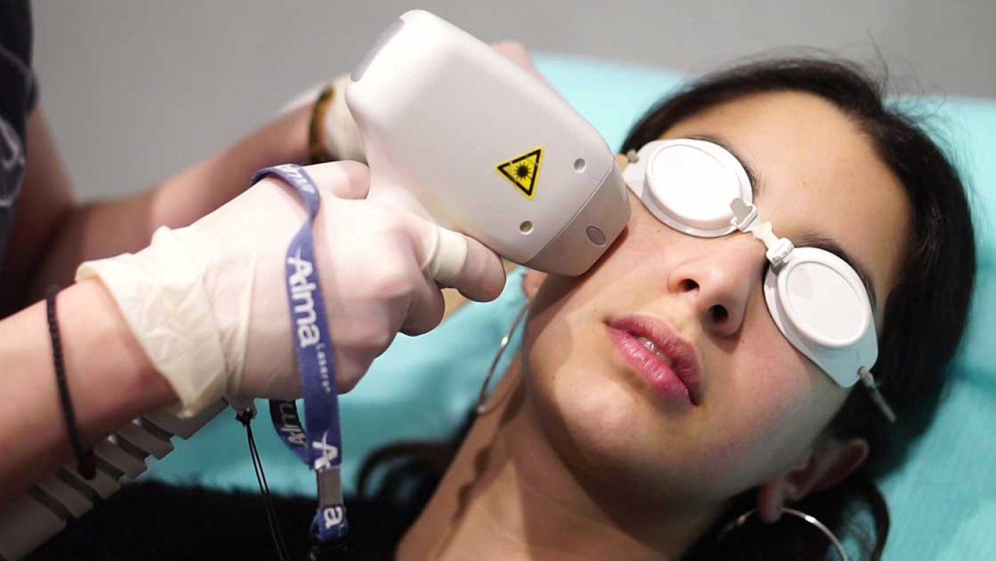 لیزر موهای صورت