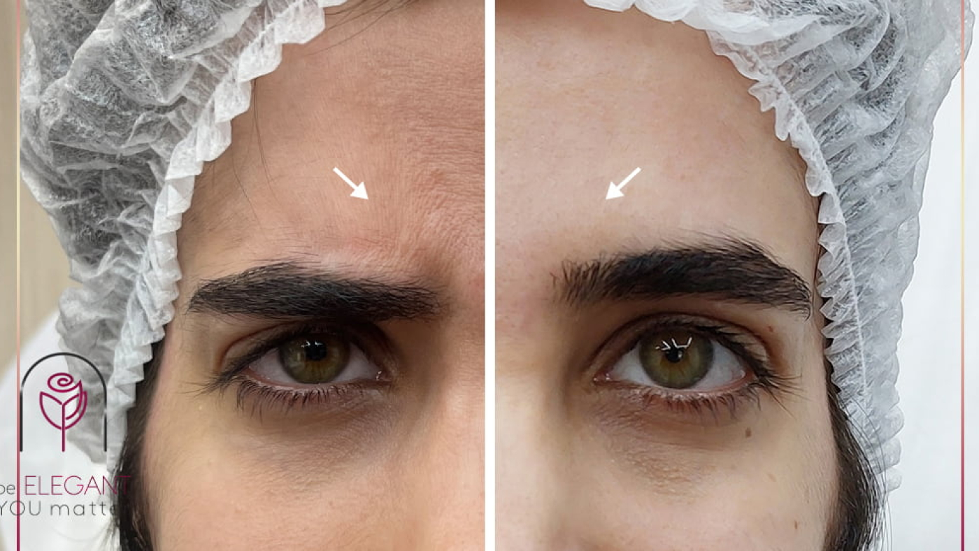 تزریق بوتاکس ساری