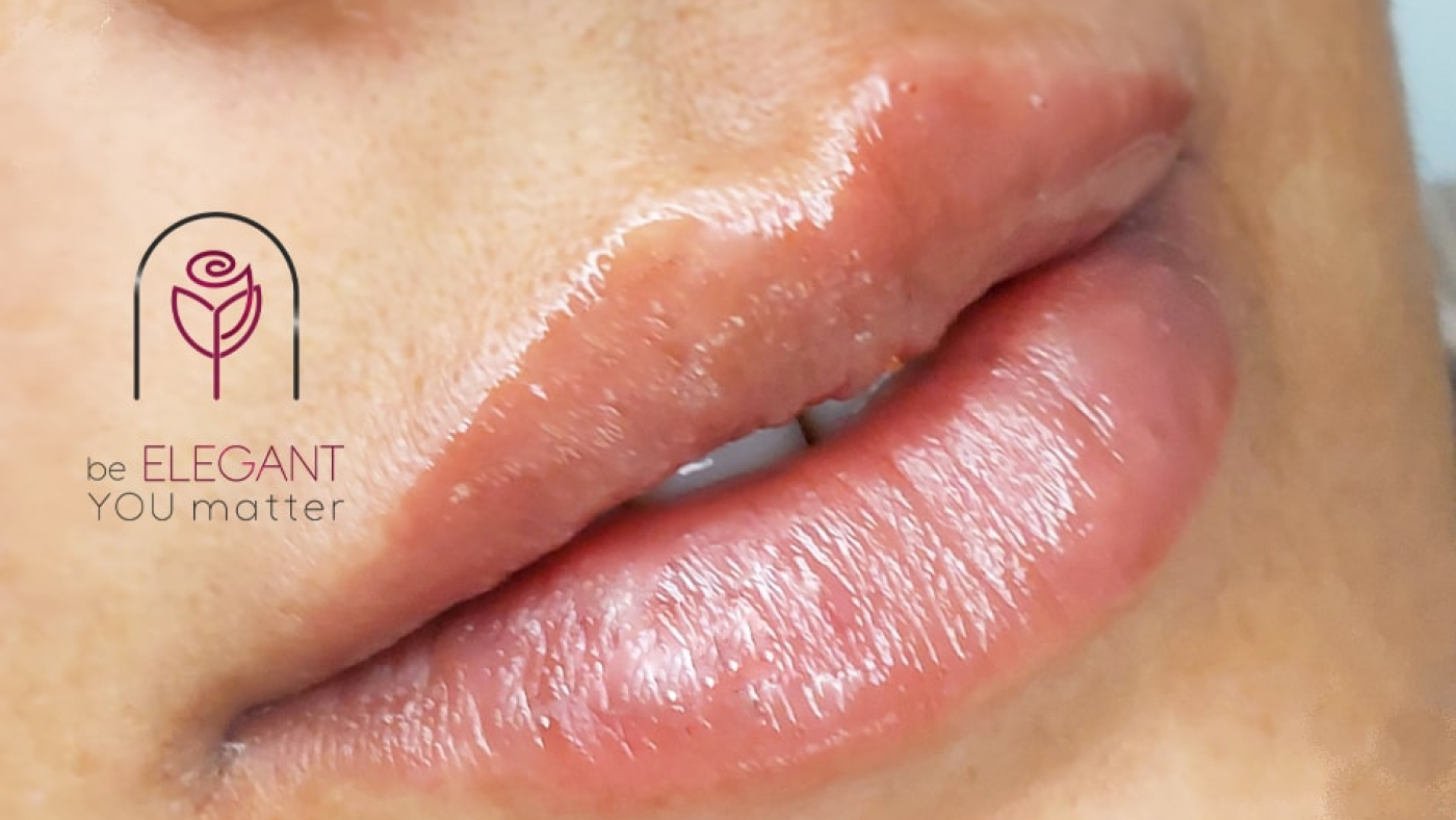 عوارض تزریق ژل لب