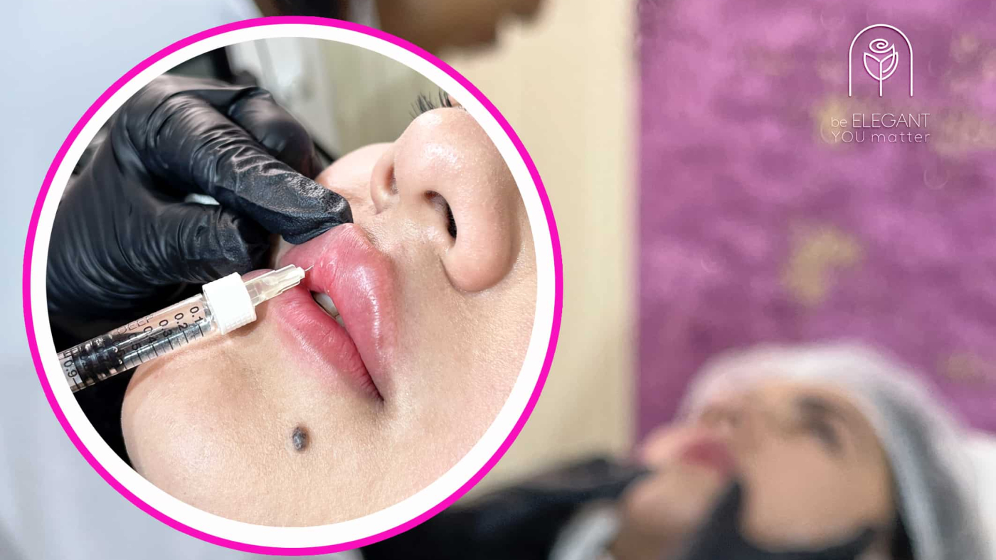 تزریق فیلر و ژل در ساری