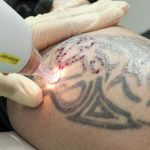 عوارض جانبی پاک کردن تتو با لیزر