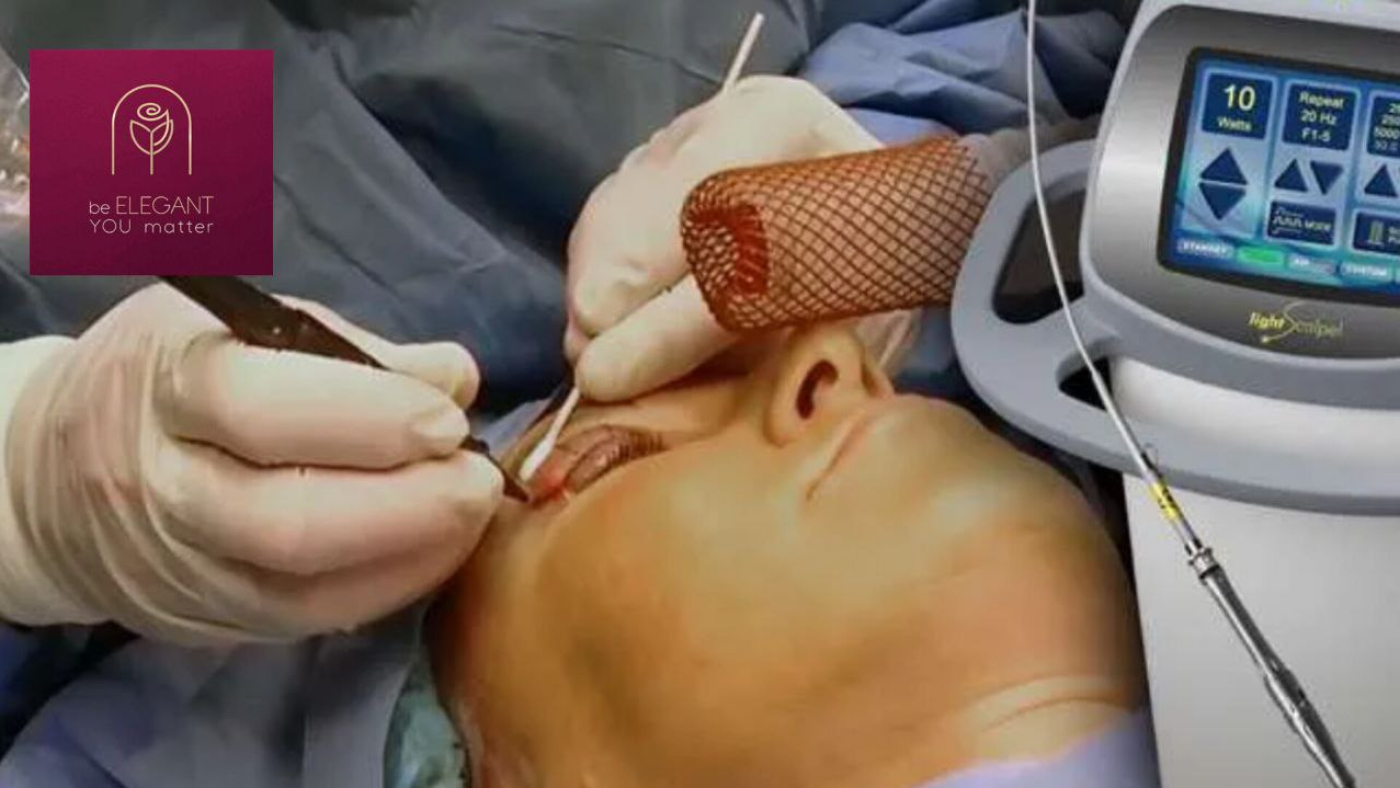 بلفاروپلاستی با لیزر